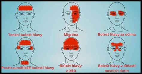 vizuální přehled typů bolestí hlavy